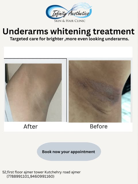 ✨ Underarms Whitening Treatment ✨

Say goodbye to dark underarms and hello to smoother, brighter-loo