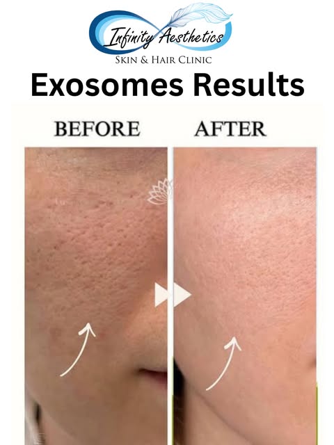 ✨ Give Your Skin the Power of Exosomes ✨

Advanced Skin Exosome Therapy supports skin rejuvenation a
