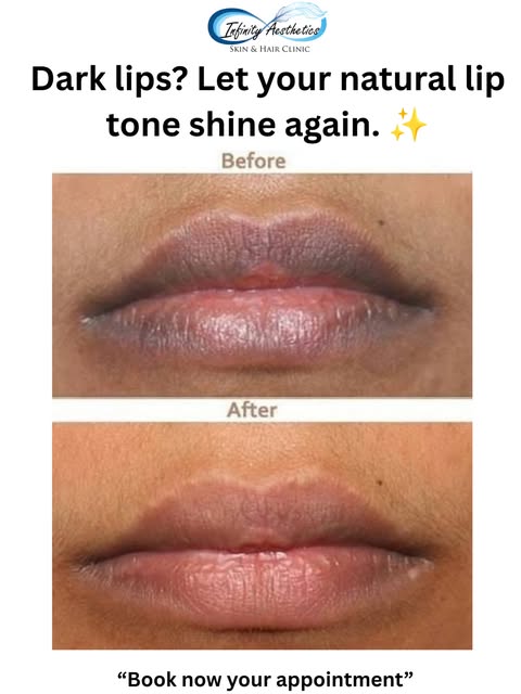 Dark or uneven lips? 💋✨
Bring back the natural-looking glow of your lips with our Lip Pigmentation 