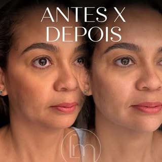 Menos exagero. Mais equilíbrio. Mais naturalidade.

O segredo de uma boa harmonização facial não é m