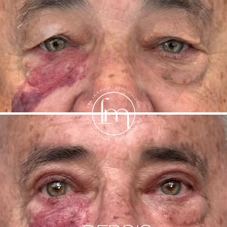 Um resultado que vai muito além da estética. ✨

Neste antes e depois de blefaroplastia, devolvemos l