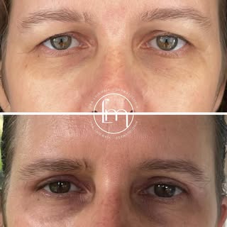 1 ano após cirurgia de pálpebras. Um resultado que permanece! 🤩

Além da melhora estética, a cirurg
