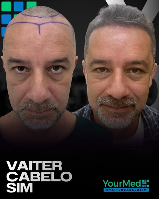 ANTES E DEPOIS TRANSPLANTE CAPILAR YOURMED ✅

Uma transformação que vai muito além dos fios.

Mais c
