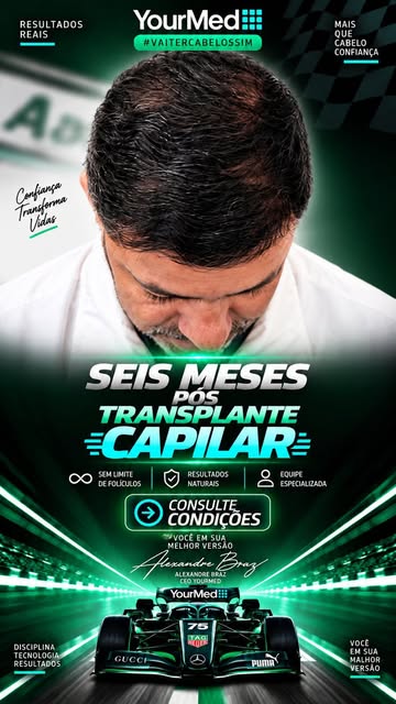 Seis meses pos Transplante Capilar na Yourmed VaiTerCabeloSim