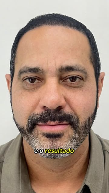RESULTADO DE TRANSPLANTE CAPILAR NA YOURMED | 4 MESES ✅

Em apenas 4 meses, já é possível perceber u