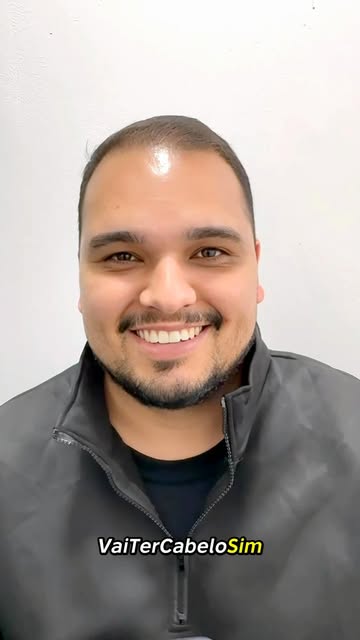 RESULTADO DE TRANSPLANTE CAPILAR 3 MESES ✅

Nosso paciente João Vitor, com apenas 3 meses de procedi