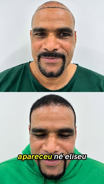 Nove meses de evolução e muita satisfação com o resultado! Nosso paciente compartilha como está feli