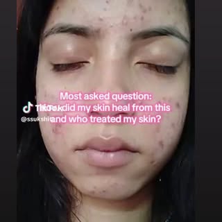 #happyclient #skinhairandlaserclinic #dermatologist #dranilkumarbhatta #anesthetics #dermdynamics #p