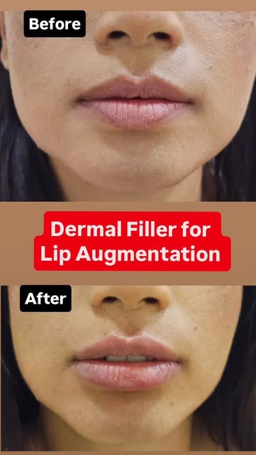 Dermal Filler for Lip Augmentation 
#dermdynamicsskinhairanddlaserclinc #dranilkumarbhatta #dermalfi