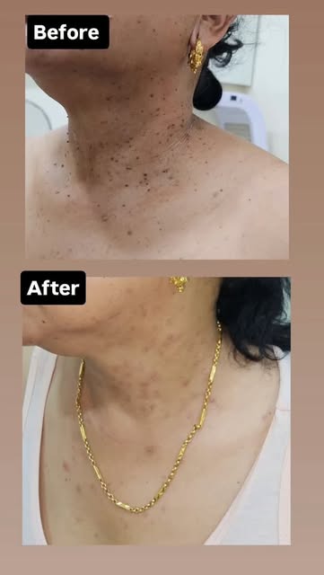 Co2 Laser Treatment for Skin Tag 
#dermdynamicsskinhairanddlaserclinc #dranilkumarbhatta #co2lasertr