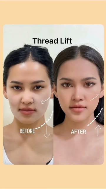 Thread Lifting Treatment 
#dermdynamicsskinhairanddlaserclinc #dranilkumarbhatta #dermatologist #sum