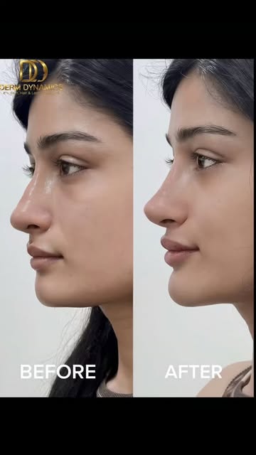 Dermal Filler for Nose Augmentation 
#dermdynamicsskinhairanddlaserclinc #dranilkumarbhatta #dermato