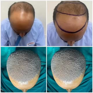 Dr Madhusoodan Gupta  #plasticsurgeons #cosmeticsurgery #HairTransplant #HairTransplantResults #fueh