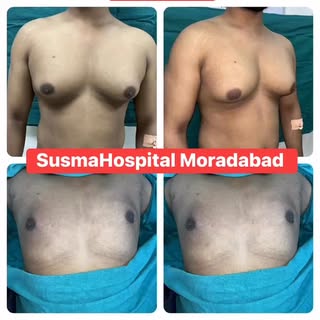 @Dr Madhusoodan Gupta  #Gynecomastia #liposuction #ScarlessGynecomastia #cosmeticsurgery #moradabad 
