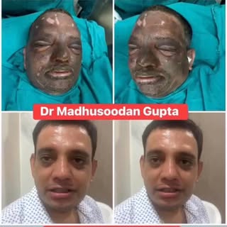 Dr Madhusoodan Gupta 
 Dr Madhusoodan Gupta - Sushma Hospital, Kanth Road, Moradabad #flameburn #Fac