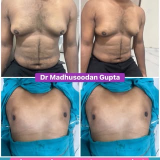 Gynecomastia Surgery at Sushma Hospital Moradabad by Board Certified Plastic Surgeon Dr Madhusoodan 