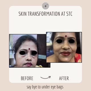 If you are worried about prominent under eye bags which are affecting your confidence but don’t want