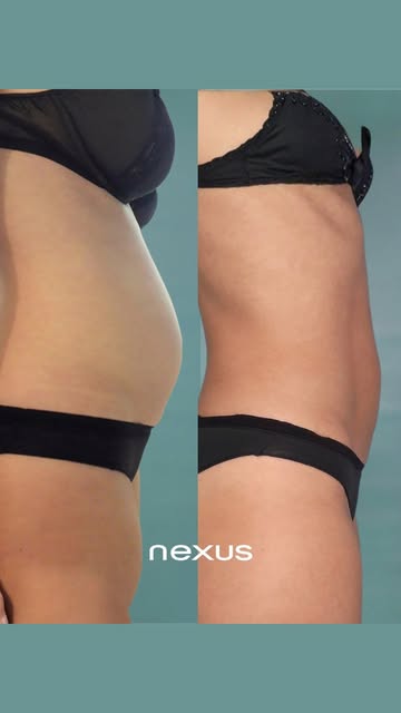 @mis_twins se ha realizado el tratamiento EmSculpt Neo, una tecnología avanzada que combina estimula