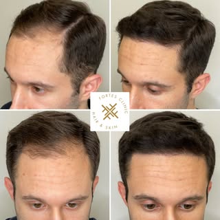 32 years old Norwood 3 Male-Pattern hair loss with receding hairline, frontal and temple thinning.

