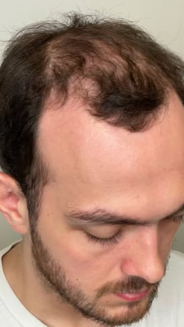 ‼️ Class 4 male-pattern baldness 
💉FUE procedure
🔬number of grafts 3000
⏳results after 12 months 
