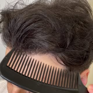 25 years old Norwood 3 Male-Pattern hair loss with receding hairline, frontal and temple thinning.

