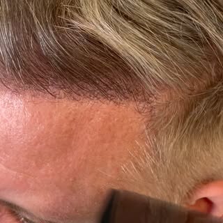 49 years old Norwood 3 Male-Pattern hair loss with receding hairline, frontal and temple thinning.

