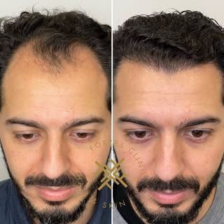 38 years old Norwood 3 Male-Pattern hair loss with receding hairline and temple thinning.

Procedure