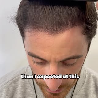 ‼️ Can you see the results as early as 6 months after hair transplant ❓
The answer is in this video 