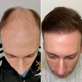 35 years old Norwood 6 Male-Pattern hair loss with advanced thinning 

Procedure: FUE / sapphire tec