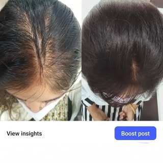 Facing hairfall problems? Not feeling confident? 100% results for diffuse alopecia with PRP at Skin 