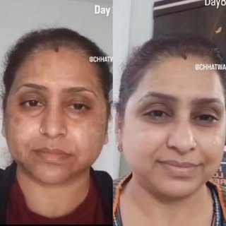 Recovery journey post-fractional CO2 laser resurfacing
And Skin Tightening 
So what are u waiting fo
