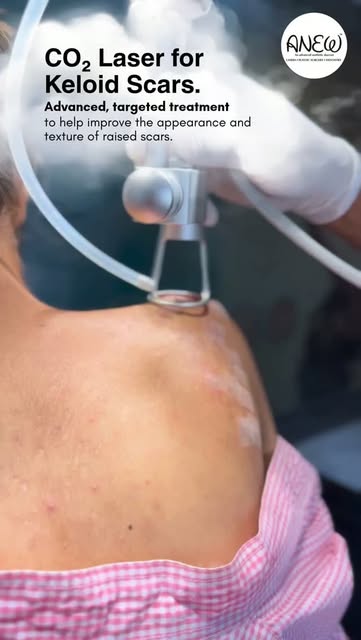 Keloid scars can be more than just a mark on the skin. ✨

CO₂ Laser Keloid Treatment uses controlled