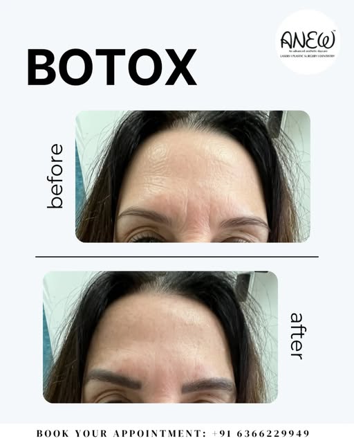 Botox — Fresh Face, Fewer Lines. 💉✨

A subtle refresh, a smoother look, and confidence that still f
