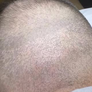 Correction de cicatrices suite à une greffe de FUE 🖊️

Hair Repair Formation - Centre de formation 