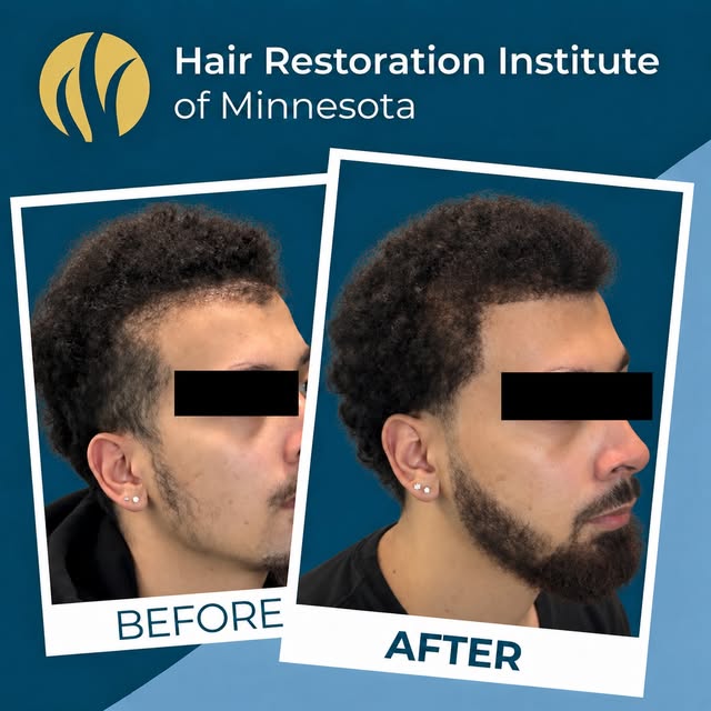 A transformation that looks natural from every angle.

Hair restoration isn’t simply about adding ha