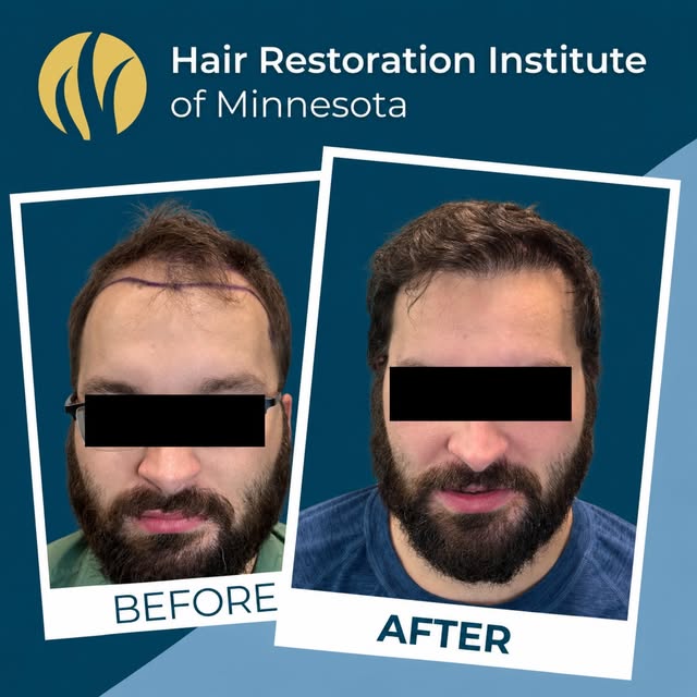 He was only 26—but his receding hairline made him feel as though he looked far older.

He came to HR