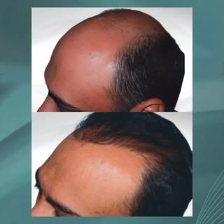El trasplante de cabello le devolvio una imagen mucho más juvenil y aumentó su autoestima debido a l