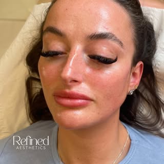 Profile balancing✨

Swipe for the before ->

Here we treated the chin, cheeks, and jaw to add defini