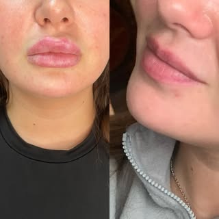 LIP DISSOLVING🤍 

My client came to me with overfilled & migrated lips (previously done elsewhere).