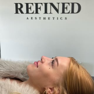 Non surgical rhinoplasty results🥰

Tweaks to the nose without the surgical downtime or cost!  Non s