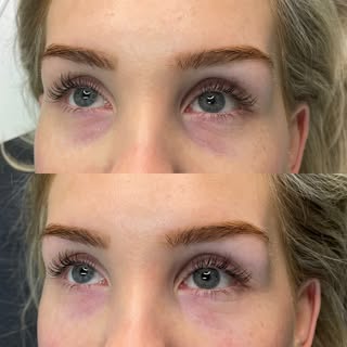 Tear trough filler before & after🌟

Natural but noticeable results! Tear trough filler lifts the un