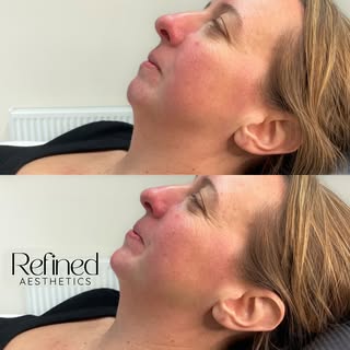 Tweaks to the side profile with chin filler🤌🏼

Chin filler can reshape and redefine your jawline, 