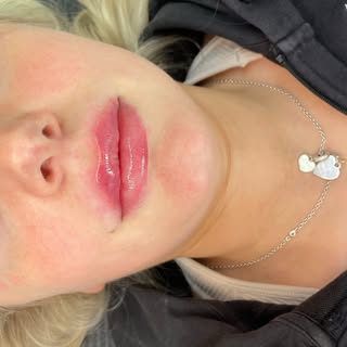 0.5ml top up to maintain these gorgeous lips☁️

Swelling is present, lips will go down by around 20-