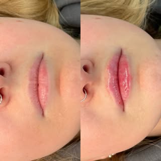 Natural tweaks are the best🥰

#lipenhancement #dermalfiller #medicalaesthetics #leedsaesthetics #na