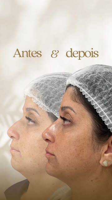 Por que tratar o perfil de forma integrada faz TODA a diferença? 📐✨

Muitas vezes, a queixa do paci