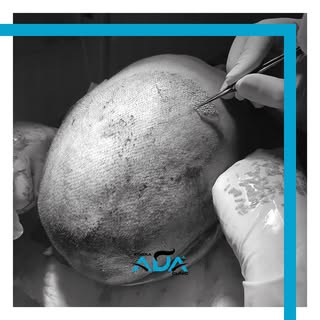 #hairtransformation #hairtransplant #hairtransplantation #doctor #hairtransplantturkey #hairtranspla