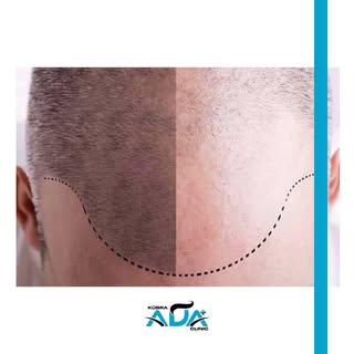 #hairtransformation #hairtransplant #hairtransplantation #doctor #hairtransplantturkey #hairtranspla
