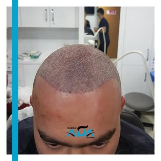 #hairtransformation #hairtransplant #hairtransplantation #doctor #hairtransplantturkey #hairtranspla