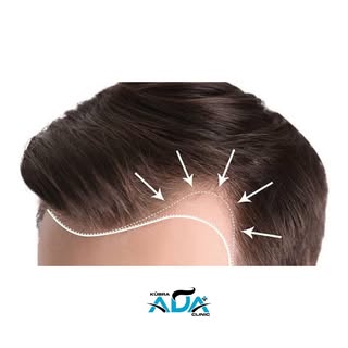 #hairtransformation #hairtransplant #hairtransplantation #doctor #hairtransplantturkey #hairtranspla