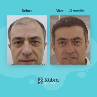 It’s time to get your younger look back — FUE #hairtransplant is the most affordable treatment for y